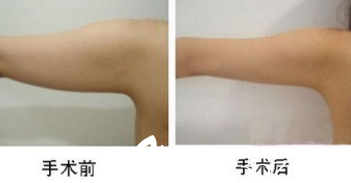 韩国Ree&Ahn Clinic安俊泰手臂吸脂案例