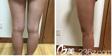 在韩国Ree&Ahn Clinic医院做腿部吸脂前效果 在韩国Ree&Ahn Clinic医院做腿部吸脂前效果