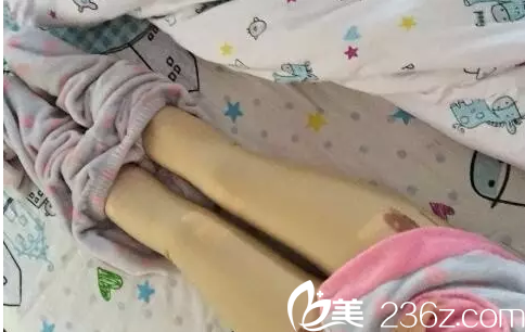 Ree&Ahn Clinic腿部吸脂第2天样子 Ree&Ahn Clinic腿部吸脂第2天样子