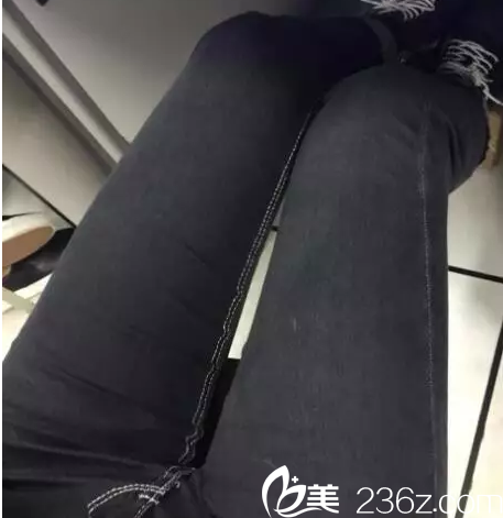 Ree&Ahn Clinic安俊泰腿部吸脂案例 Ree&Ahn Clinic安俊泰腿部吸脂案例