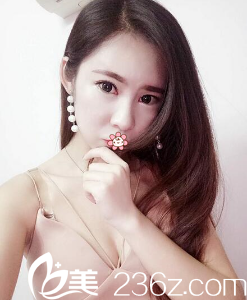 贵阳美莱双眼皮术后一个月 贵阳美莱双眼皮术后一个月