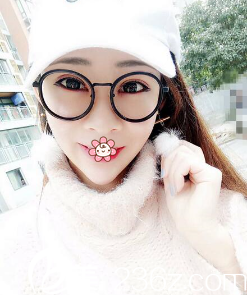 罗曼双眼皮术后14天 罗曼双眼皮术后14天