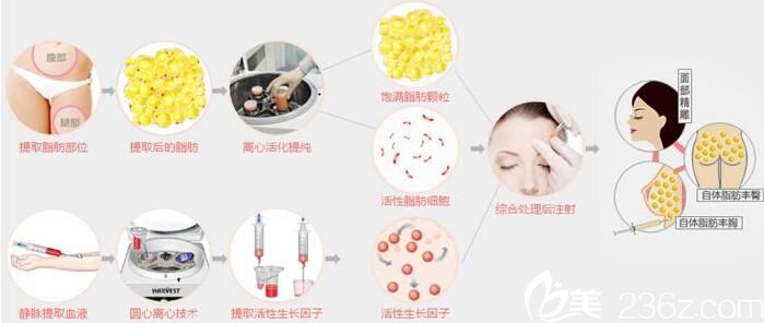 韩国金世永整形外科自体脂肪移植图 韩国金世永整形外科自体脂肪移植图