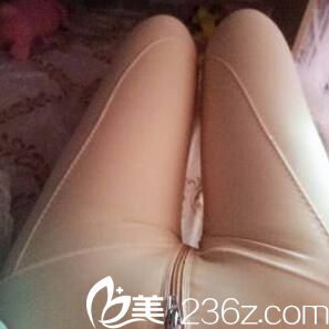 吸脂瘦大腿术后天 吸脂瘦大腿术后天