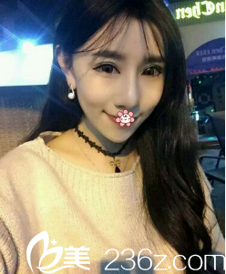 朱晓东自体脂肪全脸填充术后12天