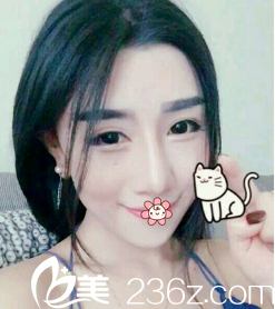 贵阳美贝尔自体脂肪全脸填充术后19天