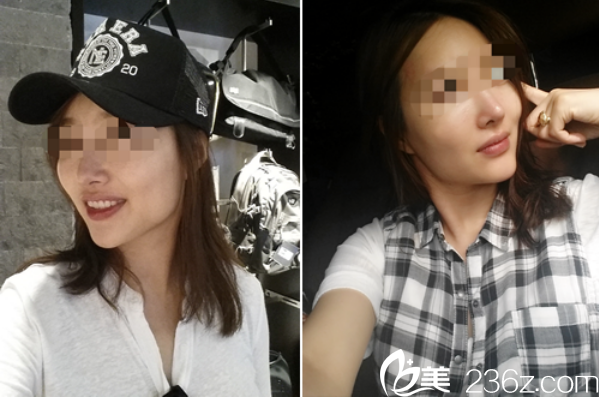 韩国爱宝live四方脸改善手术前后对比 韩国爱宝live四方脸改善手术前后对比