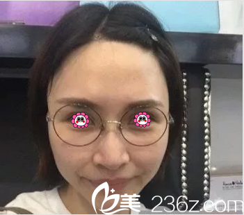 在北京壹加壹做埋线提升前样子 在北京壹加壹做埋线提升前样子