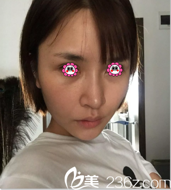 在北京壹加壹找田莹做埋线提升第7天效果 在北京壹加壹找田莹做埋线提升第7天效果