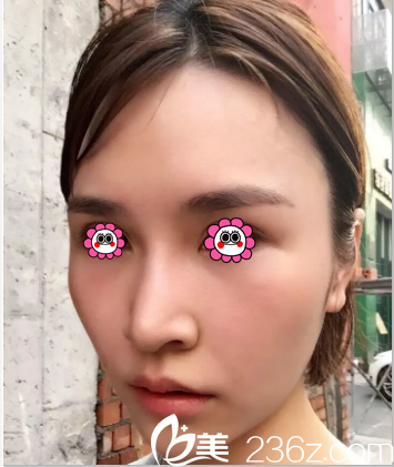 北京壹加壹田莹意大利悦升提拉+童颜铃铛线半月效果 北京壹加壹田莹意大利悦升提拉+童颜铃铛线半月效果