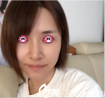 田莹意大利悦升提拉+童颜铃铛线案例 田莹意大利悦升提拉+童颜铃铛线案例