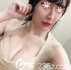 韩国POINT整形外科假体隆胸术后23天 韩国POINT整形外科假体隆胸术后23天