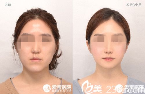 韩国爱宝(Everm)整形医院双鄂手术案例对比图 韩国爱宝(Everm)整形医院双鄂手术案例对比图