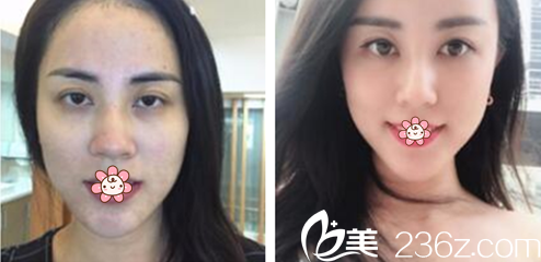 周邓霆主任面部线雕案例 周邓霆主任面部线雕案例