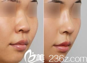 韩国芭比整形外科隆鼻手术案例对比图