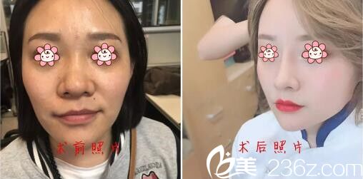 韩国PRIME整形外科金永灿鼻修复案例