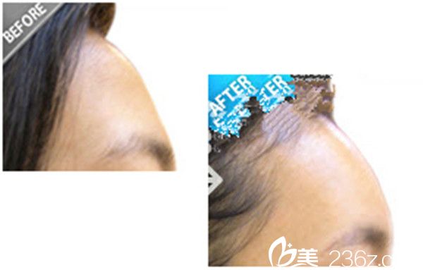 崔锡勋院长自体脂肪丰额头案例 崔锡勋院长自体脂肪丰额头案例