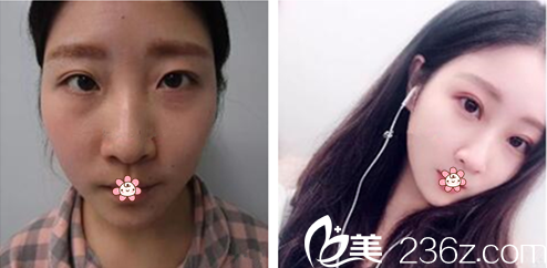 金永灿院长双眼皮修复案例 金永灿院长双眼皮修复案例