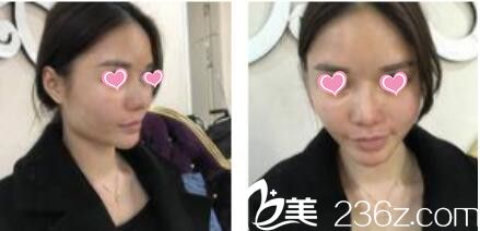 韩国金在中整形外科金在中假体隆鼻真人案例术前照 韩国金在中整形外科金在中假体隆鼻真人案例术前照