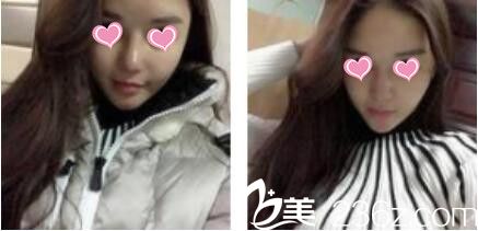 韩国金在中整形外科金在中假体隆鼻真人案例术后第七天 韩国金在中整形外科金在中假体隆鼻真人案例术后第七天