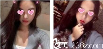 韩国金在中整形外科金在中假体隆鼻真人案例术后一个月 韩国金在中整形外科金在中假体隆鼻真人案例术后一个月