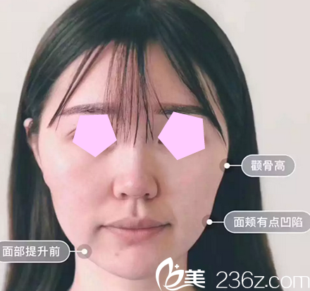 我在太原华美整形美容医院做面部线雕术前照 我在太原华美整形美容医院做面部线雕术前照