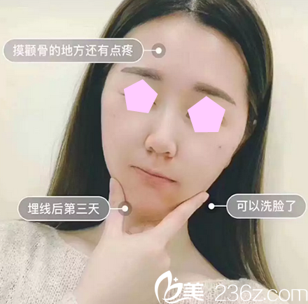 我在太原华美做脸部线雕术后第3天照片 我在太原华美做脸部线雕术后第3天照片