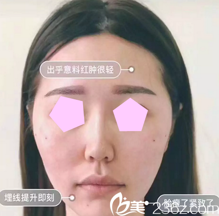 我在太原华美做面部线雕提升术后当天照片 我在太原华美做面部线雕提升术后当天照片