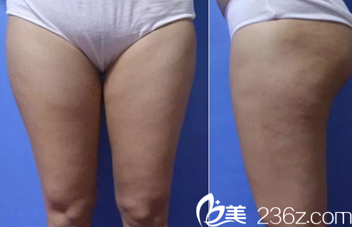 我在聊城韩美整形美容医院做腿部吸脂前照片 我在聊城韩美整形美容医院做腿部吸脂前照片