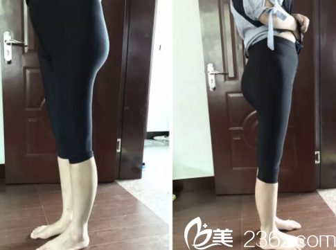 我在聊城韩美做水动力大腿吸脂术后第6天照片