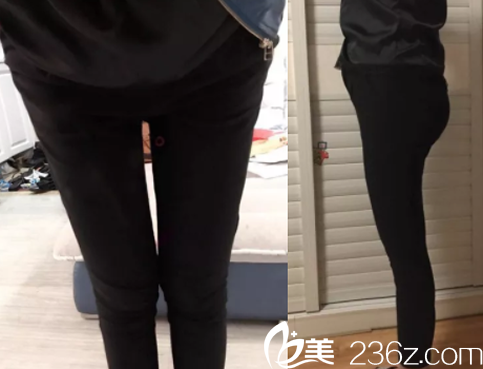 我在聊城韩美做腿部吸脂减肥术后第20天照片