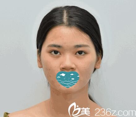 红妆尚自体软骨隆鼻术前照 红妆尚自体软骨隆鼻术前照