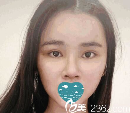 在三亚红妆尚做自体软骨隆鼻一周拆线 在三亚红妆尚做自体软骨隆鼻一周拆线