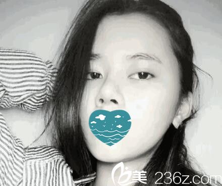 自体软骨隆鼻第九天照 自体软骨隆鼻第九天照