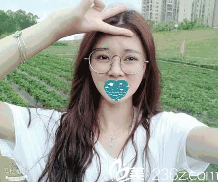 在红妆尚做自体软骨隆鼻半个月照 在红妆尚做自体软骨隆鼻半个月照