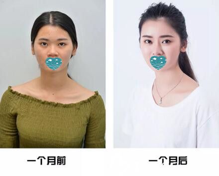 看我在三亚红妆尚医学美容做的自体软骨隆鼻1个月恢复效果怎么样