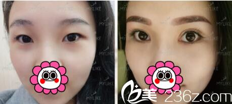 <!--<i data=20240703-sp></i>-->美莱美容医院杨继红混血电眼真人案例 <!--<i data=20240703-sp></i>-->美莱美容医院杨继红混血电眼真人案例