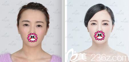 <!--<i data=20240703-sp></i>-->美莱美容医院<!--<i data=20240703-sp></i>-->原生无痕美眼真人案例 <!--<i data=20240703-sp></i>-->美莱美容医院<!--<i data=20240703-sp></i>-->原生无痕美眼真人案例