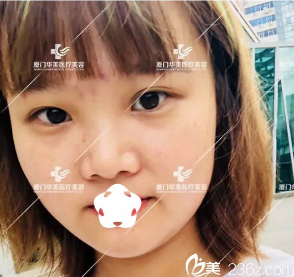 我在厦门华美整形医院做隆鼻术前照 我在厦门华美整形医院做隆鼻术前照