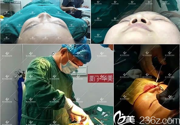 鼻综合隆鼻手术过程图 鼻综合隆鼻手术过程图