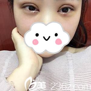 双眼皮手术第三天 双眼皮手术第三天