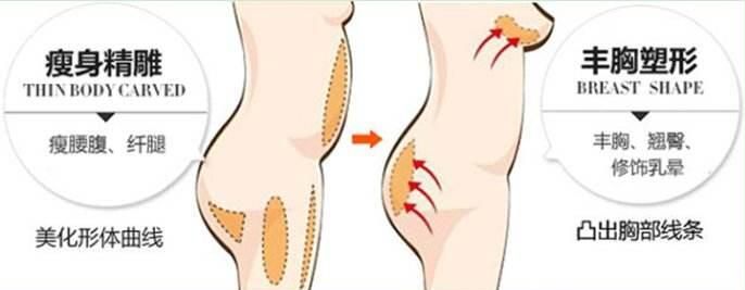 韩国快乐整形外科自体脂肪隆胸优势 韩国快乐整形外科自体脂肪隆胸优势