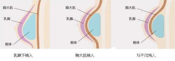 韩国快乐整形外科自体脂肪隆胸适合人群 韩国快乐整形外科自体脂肪隆胸适合人群