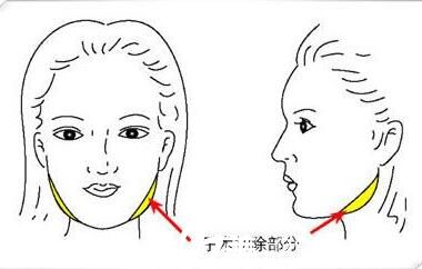 韩国快乐整形外科郑哲贤面部轮廓手术方法
