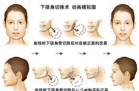 韩国快乐整形外科郑哲贤面部轮廓手术方法优缺点