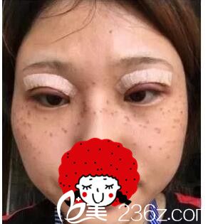 做完激光祛斑做双眼皮 做完激光祛斑做双眼皮