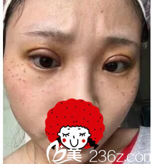 全切双眼皮术后四天恢复 全切双眼皮术后四天恢复