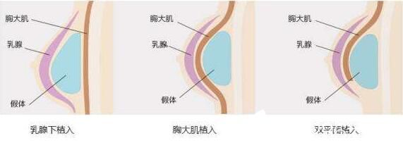 韩国快乐整形外科钟泰元假体隆胸原理 韩国快乐整形外科钟泰元假体隆胸原理