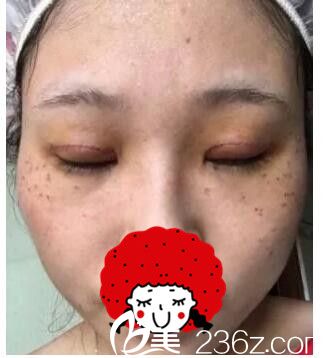 一周拆线双眼皮恢复 一周拆线双眼皮恢复