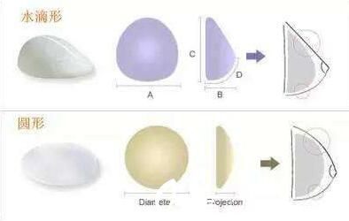 韩国快乐整形外科钟泰元假体隆胸形状 韩国快乐整形外科钟泰元假体隆胸形状